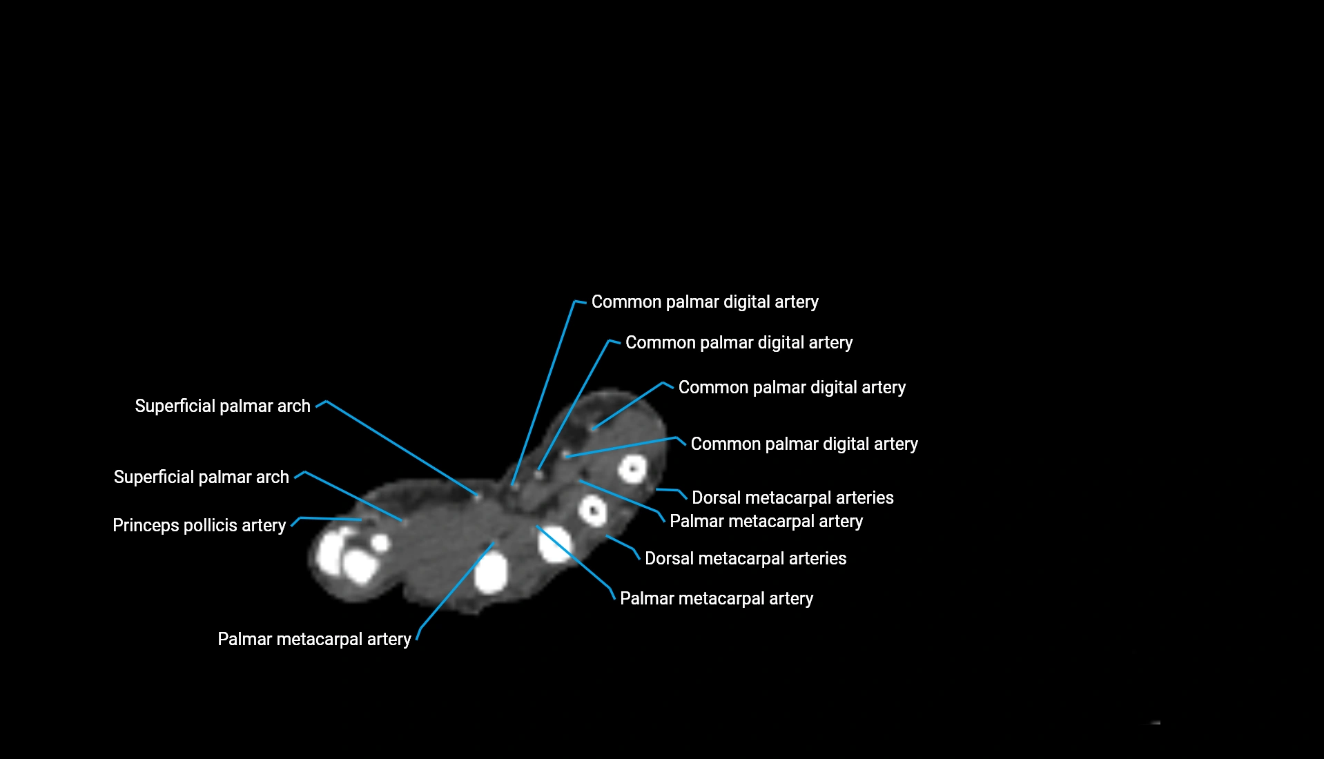 CTA upper limb axial cross sectional anatomy labelled image 59 (2).webp